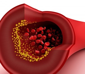 bigstock-Closeup-view-of-cholesterol-pl-40943992